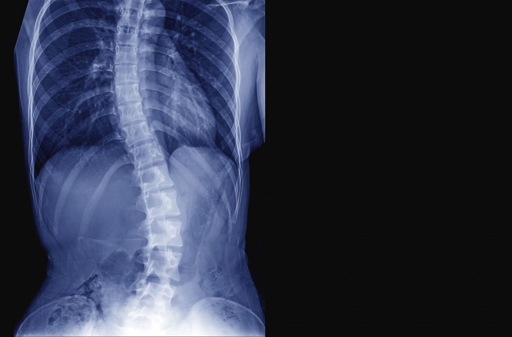 what is scoliosis