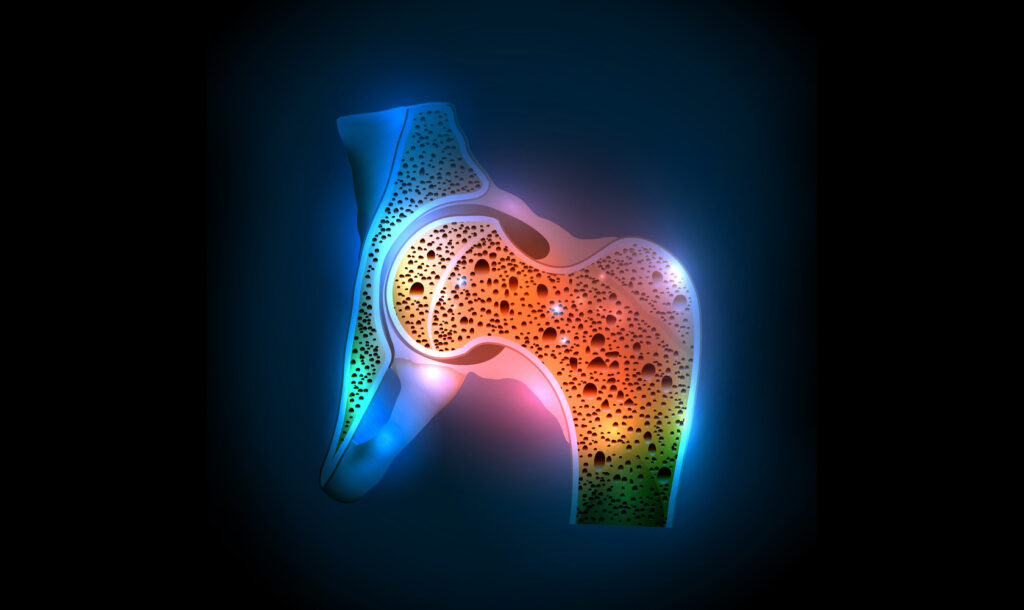 osteoporosis-physio-canberra