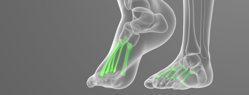 Metatarsal-Stress-Fractures