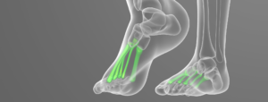 Metatarsal Stress Fractures
